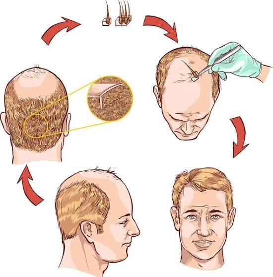 Hair restoration